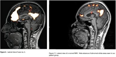 Abnormal functional MRI brain scans in EHS people