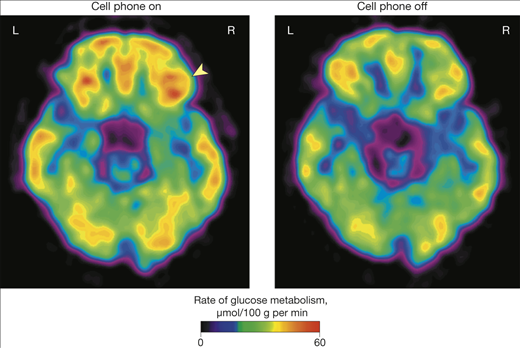 Επιδράσεις της έκθεσης σε σήματα ραδιοσυχνοτήτων κινητού τηλεφώνου στον μεταβολισμό της γλυκόζης του εγκεφάλου - Nora D. Volkow,